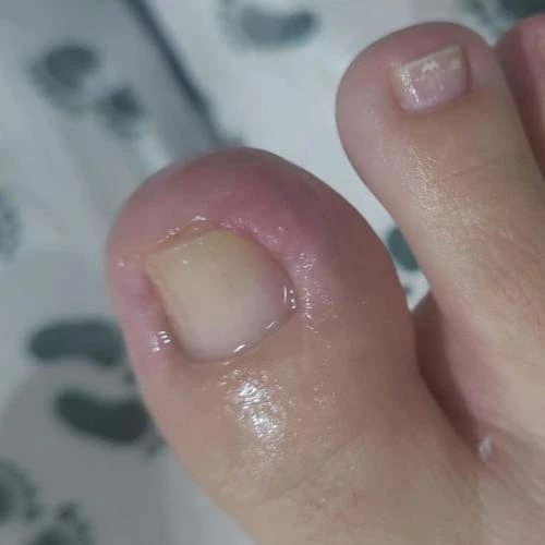 Podologa para diabéticos em São Luis