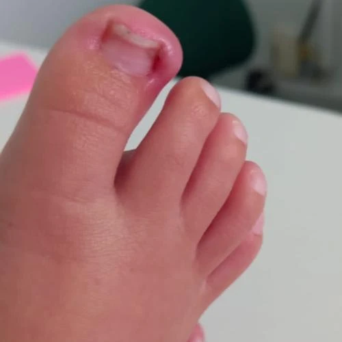 Podologia infantil em São Luis