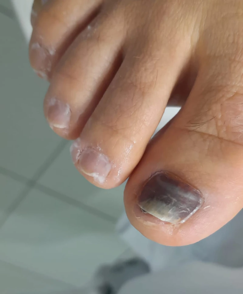 Podologia para pés diabéticos em São Luis