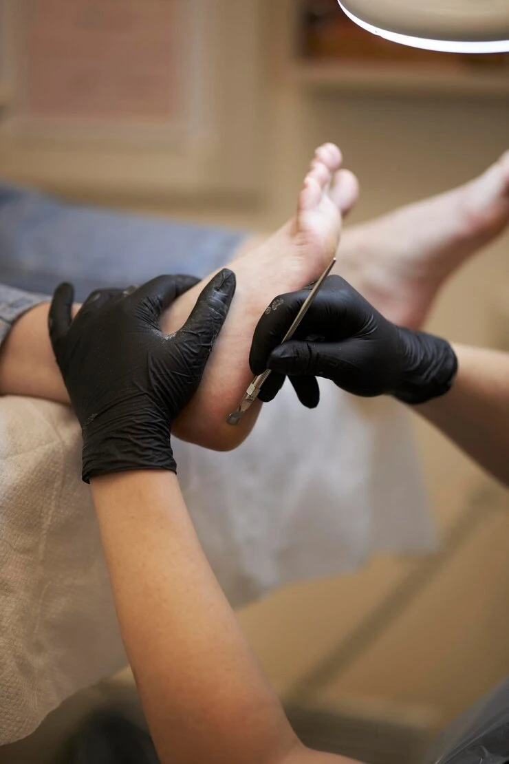 Tratamento de calosidades nos pés