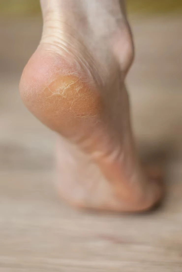 Tratamento para fissura no pé