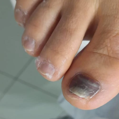 Tratamento de micose de unha diabetico com podologo