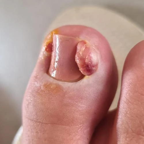 Tratamento de micose na unha do pé