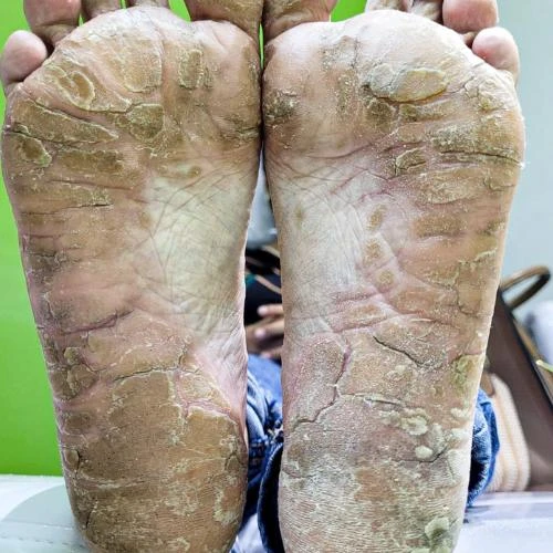 Tratamento para os pés rachados