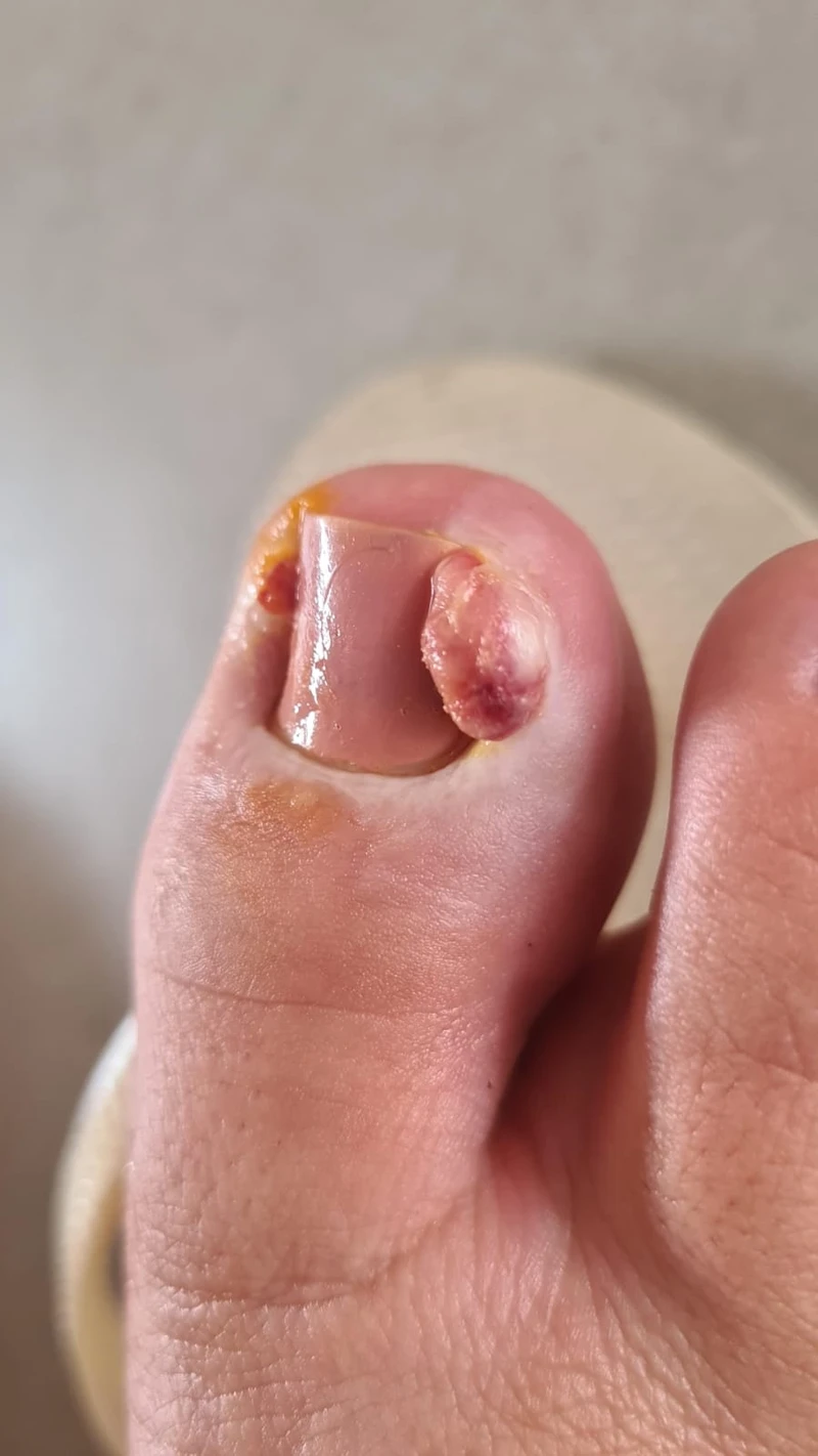 Tratamento para pés de diabéticos com podólogo