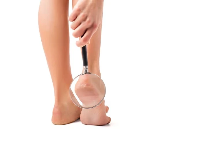 Tratamento para rachadura nos pés no Maranhão