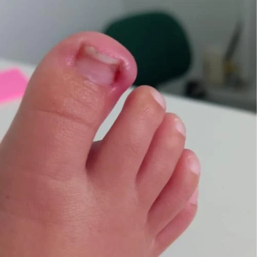 Tratamento de unha encravada infeccionada