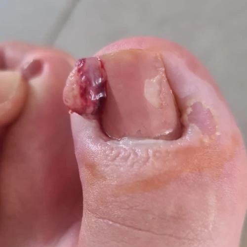 Unha encravada infeccionada​